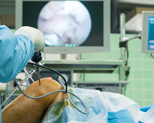 Arthroscopic Surgeries